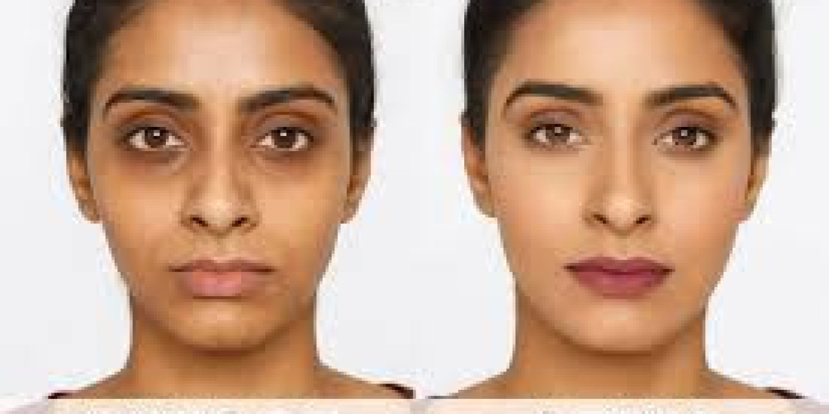 Best Dark Circles Treatment Ghaziabad – Get Brighter Eyes with Expert Care