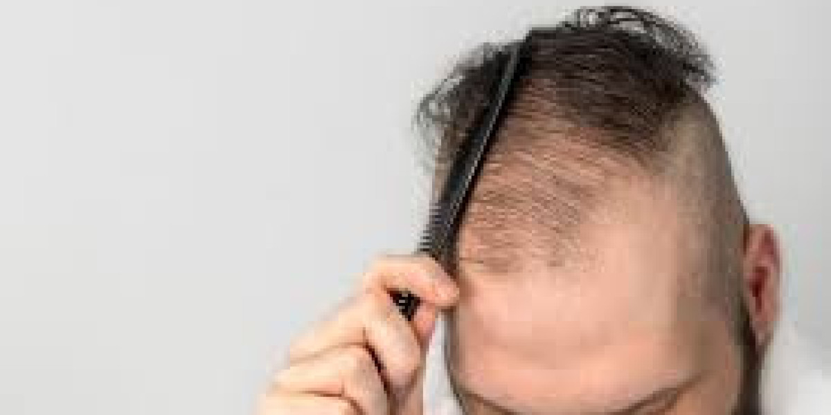 Experience the Best Hair Loss Toronto Treatment at Antech Hair & Skin Clinics