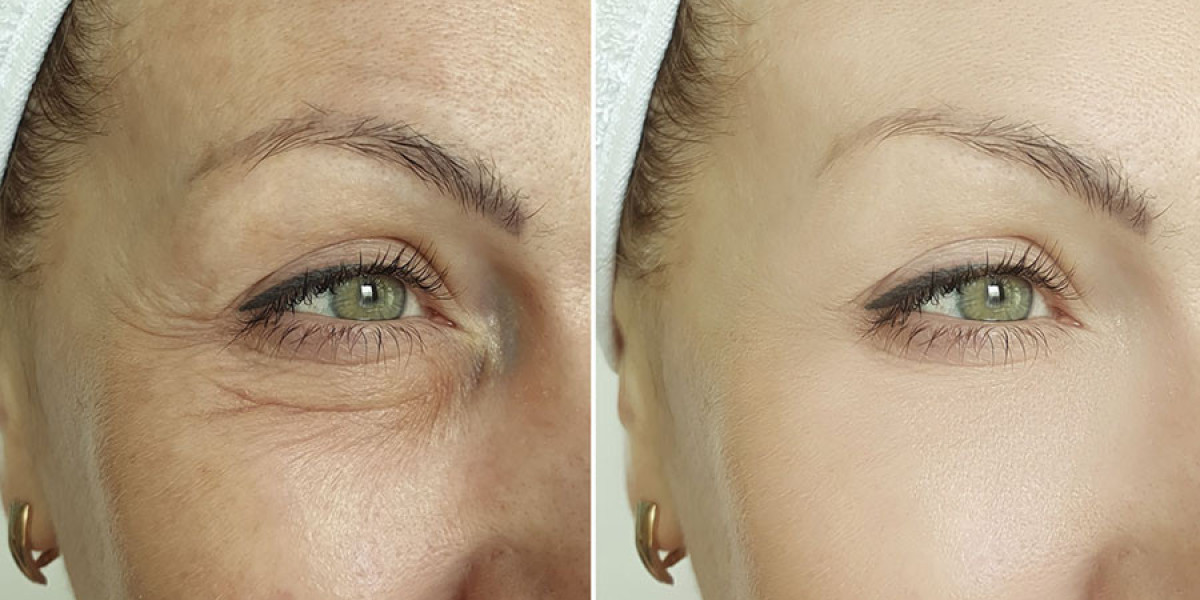 Restore Youthful Skin Naturally: Anti-Aging Microneedling Explained